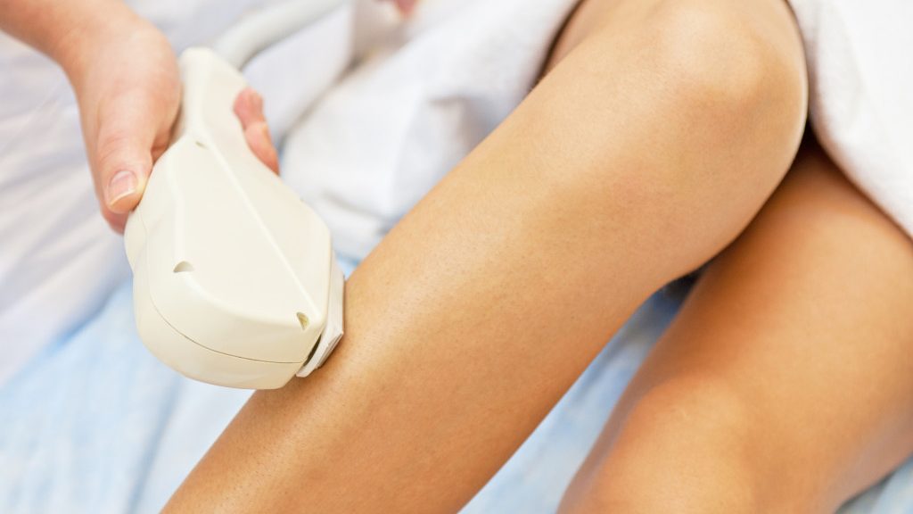 laser hair removal on female legs