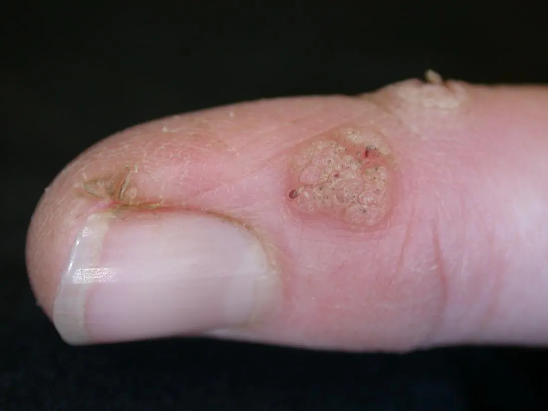 warts-types-risk-factors-medical-treatment-emedihealth