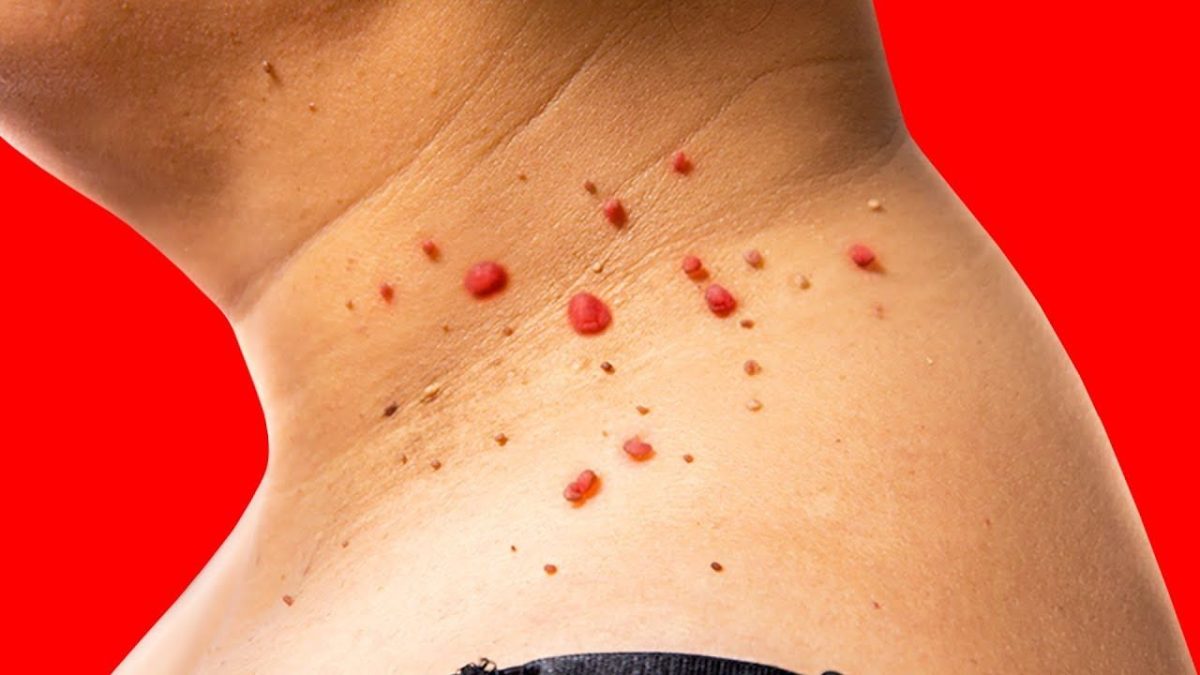 Skin Tag Removal Cost Comparison Evaluating Expenses Dr. Bratt