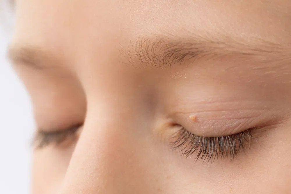 Everything You Need to Know About Skin Tag on Eyelid - Dr. Bratt